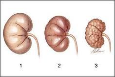 kidney-failure.jpg
